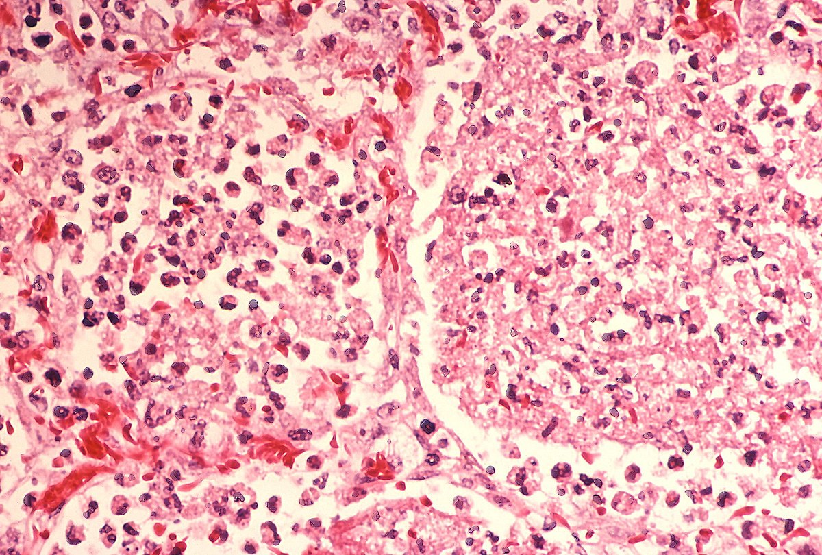 legionella